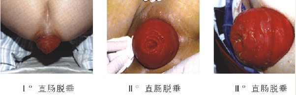 脱肛症状.jpg