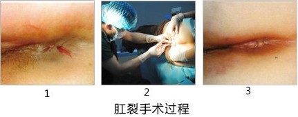 肛裂手术过程.jpg