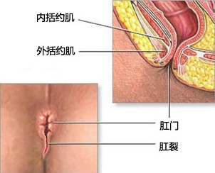 肛裂剖析图.jpg
