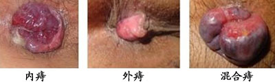 内痔、外痔、混合痔.jpg