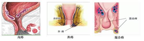 内痔外痔混合痔.jpg