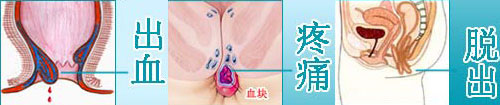 出血、疼痛、脱出.jpg
