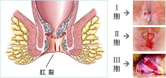 肛裂解剖图.jpg