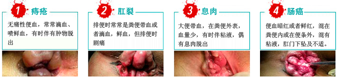 大便出血原因2015111.jpg