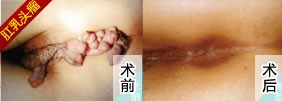 肛乳头瘤.jpg