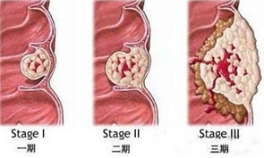 肠癌.jpg