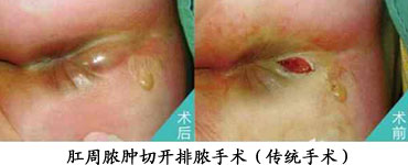 肛周脓肿传统手术.jpg