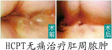 肛周脓肿.jpg