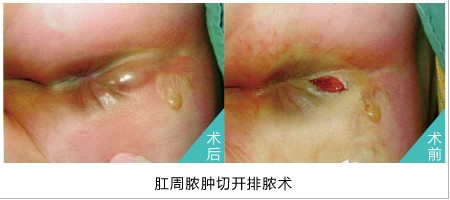 肛周脓肿治疗前后对比.jpg