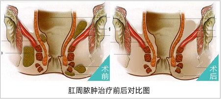 微创治疗肛周脓肿前后对比图.jpg