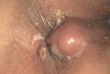 肛周脓肿3.jpg