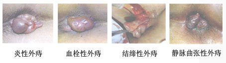 四种外痔症状2.jpg