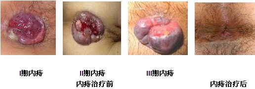 内痔治疗前后.jpg