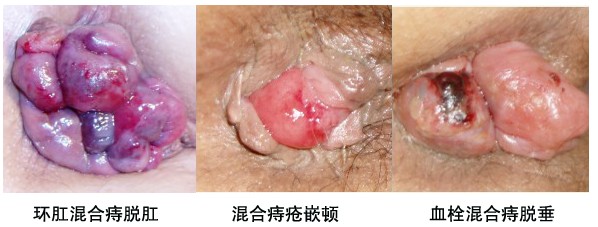 三种混合痔1.jpg