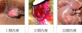 分期痔疮.jpg