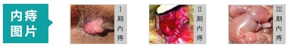 内痔图片.jpg
