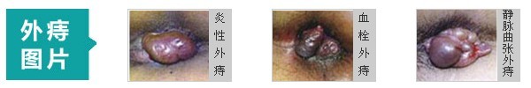 外痔图片.jpg