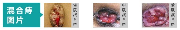 混合痔图片.jpg