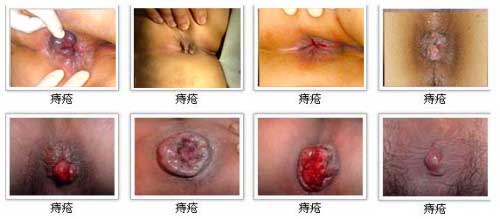 痔疮症状（8P）.jpg