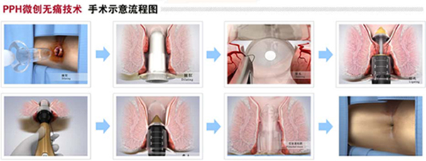 PPH微创无痛流程示意图.jpg