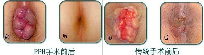 痔疮手术对比图.jpg