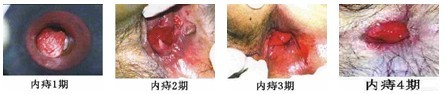 内痔分期图片.jpg