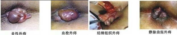 外痔.jpg