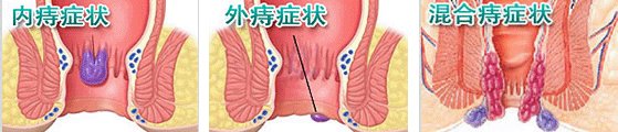 内外混合痔疮.gif