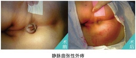 外痔对比.jpg