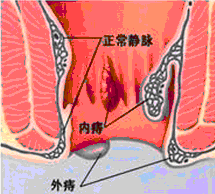 痔疮症状.gif