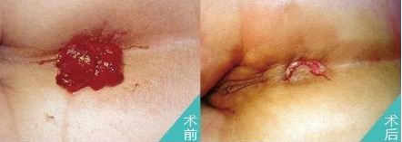 肛窦炎治疗前后.jpg