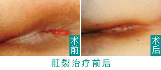 肛裂手术前后.jpg