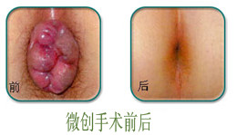 微创前后.jpg