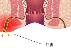 肛瘘.jpg