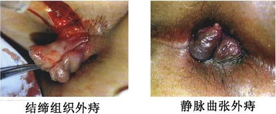外痔02.jpg