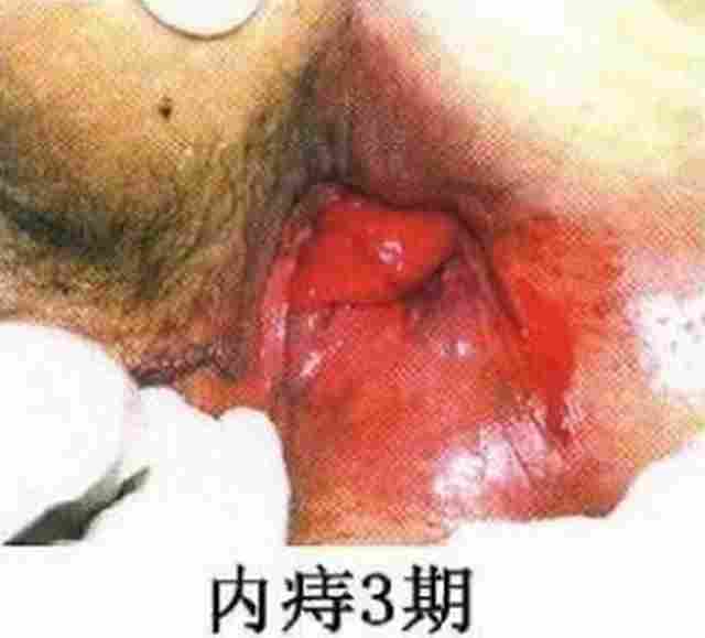 内痔3期.jpg