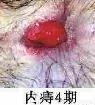 内痔4期.jpg