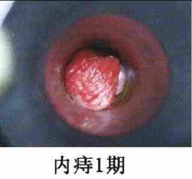 内痔1期.jpg