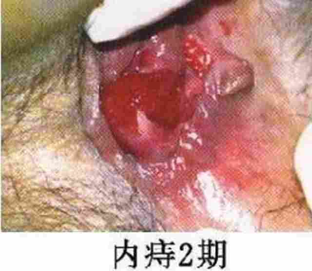 内痔2期.jpg