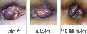 三种痔.jpg
