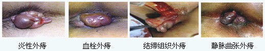 四种外痔.jpg