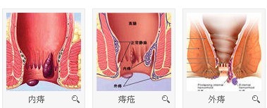 内痔 外痔 混合痔.jpg
