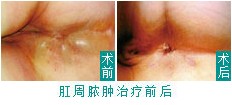 肛周脓肿治疗前后.jpg