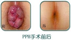 PPH治疗痔疮.jpg