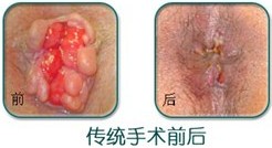 内痔治疗前后.jpg