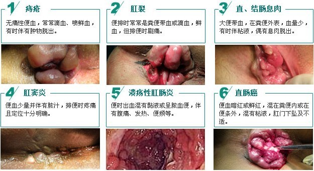 点击在线咨询肛肠专家