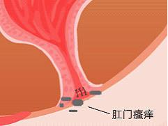 肛门瘙痒.jpg