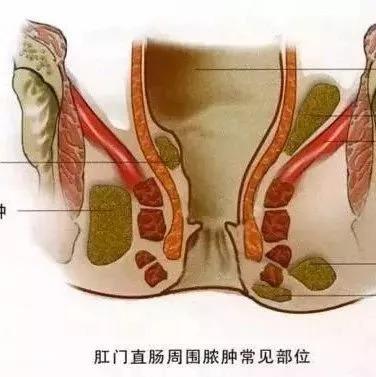 肛周脓肿怎么办？恶化成肛瘘概率高吗？