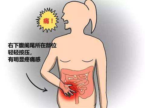 广州东大肛肠医院收费怎么样 怎样判断是否得了阑尾炎